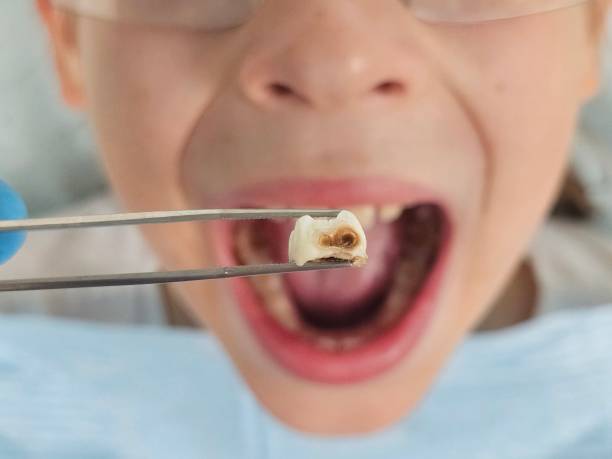 Best Emergency Wisdom Teeth Removal in Rson, CA